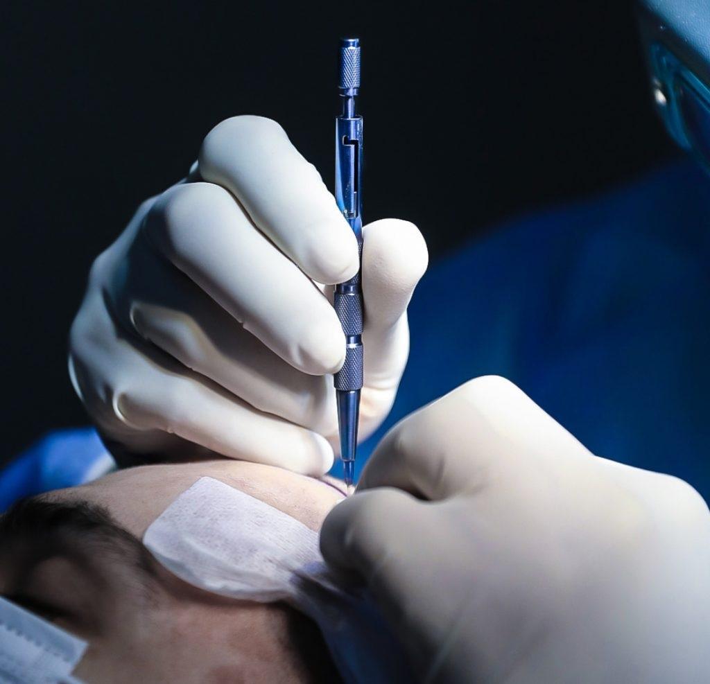 A hajbeültetés véglegesen megszünteti a kopaszságot Hajbeültetéssel a kopaszodás ellen