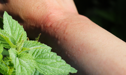 Csaláncsípés kezelése természetesen Természetes megoldások csalálncsípés ellen