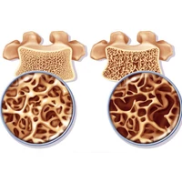 5 tipp csontritkulás ellen