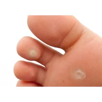 Tyúkszem kezelése házilag 