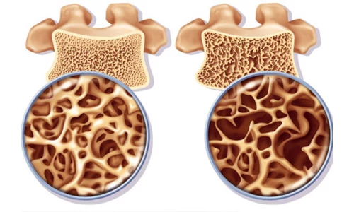5 tipp csontritkulás ellen