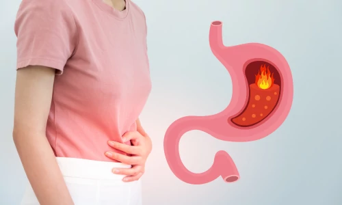 Gyomorégés, gyomorsav túltengés természetes gyógymódjai